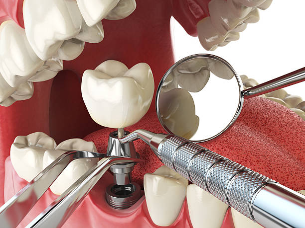 Best Emergency Dentist for Lost Fillings or Crowns in Anthony, TX